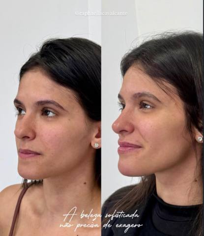 Perfiloplastia