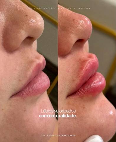 Preenchimento labial