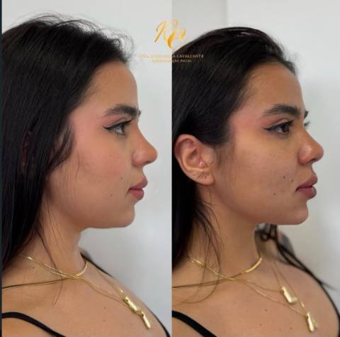 Harmonização facial