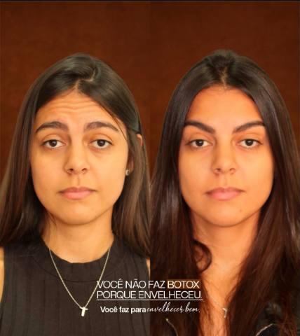 Botox