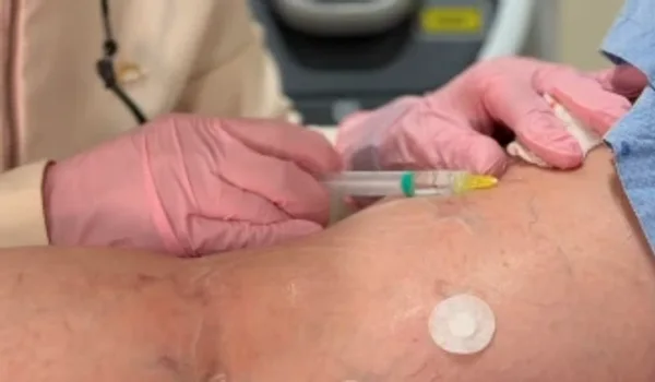 Escleroterapia (secagem de vasinhos)